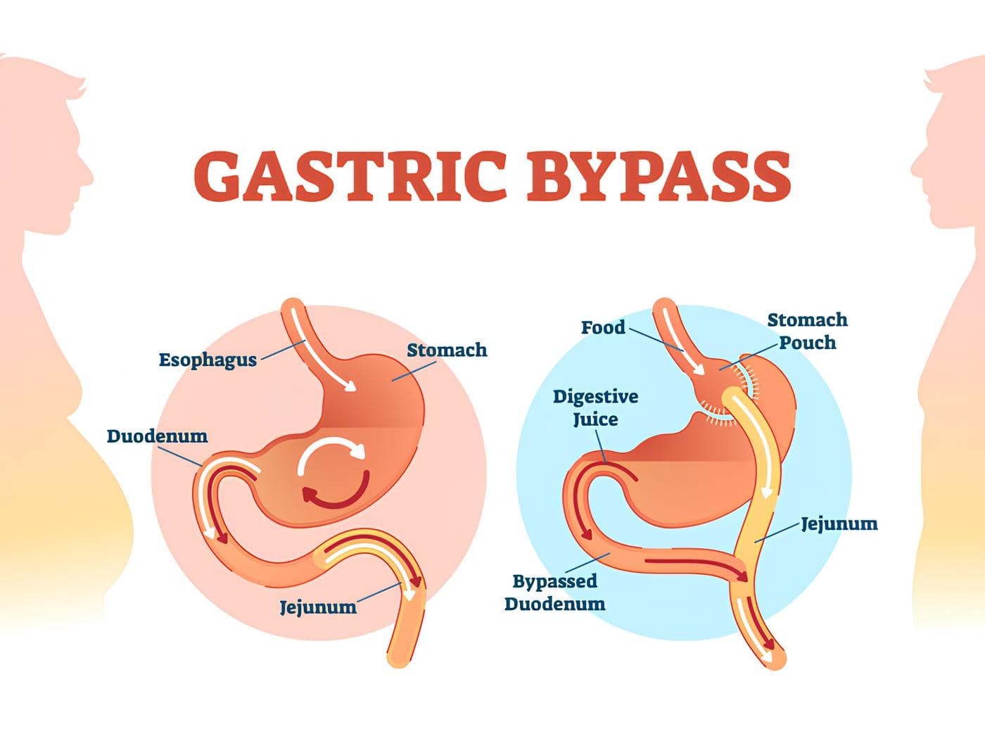 Bypass gastrico chirurgia SICOB Amici Obesi